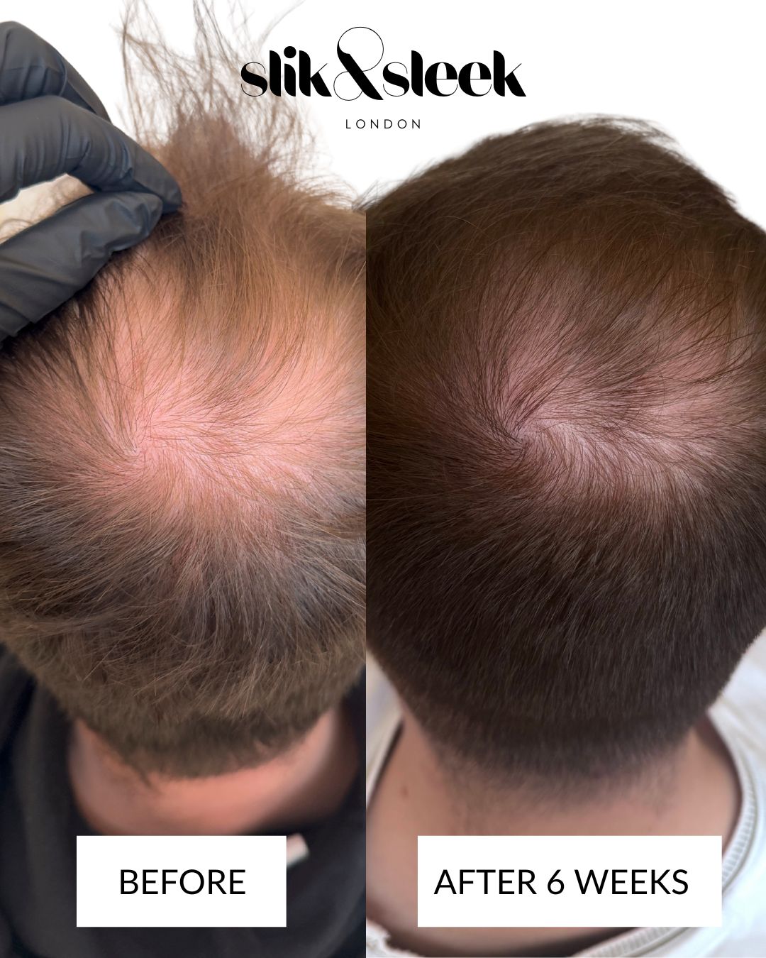 Before and after using slik&sleek london dermaroller 6 weeks hairgrowth journey with microneedling treating male pattern boldness